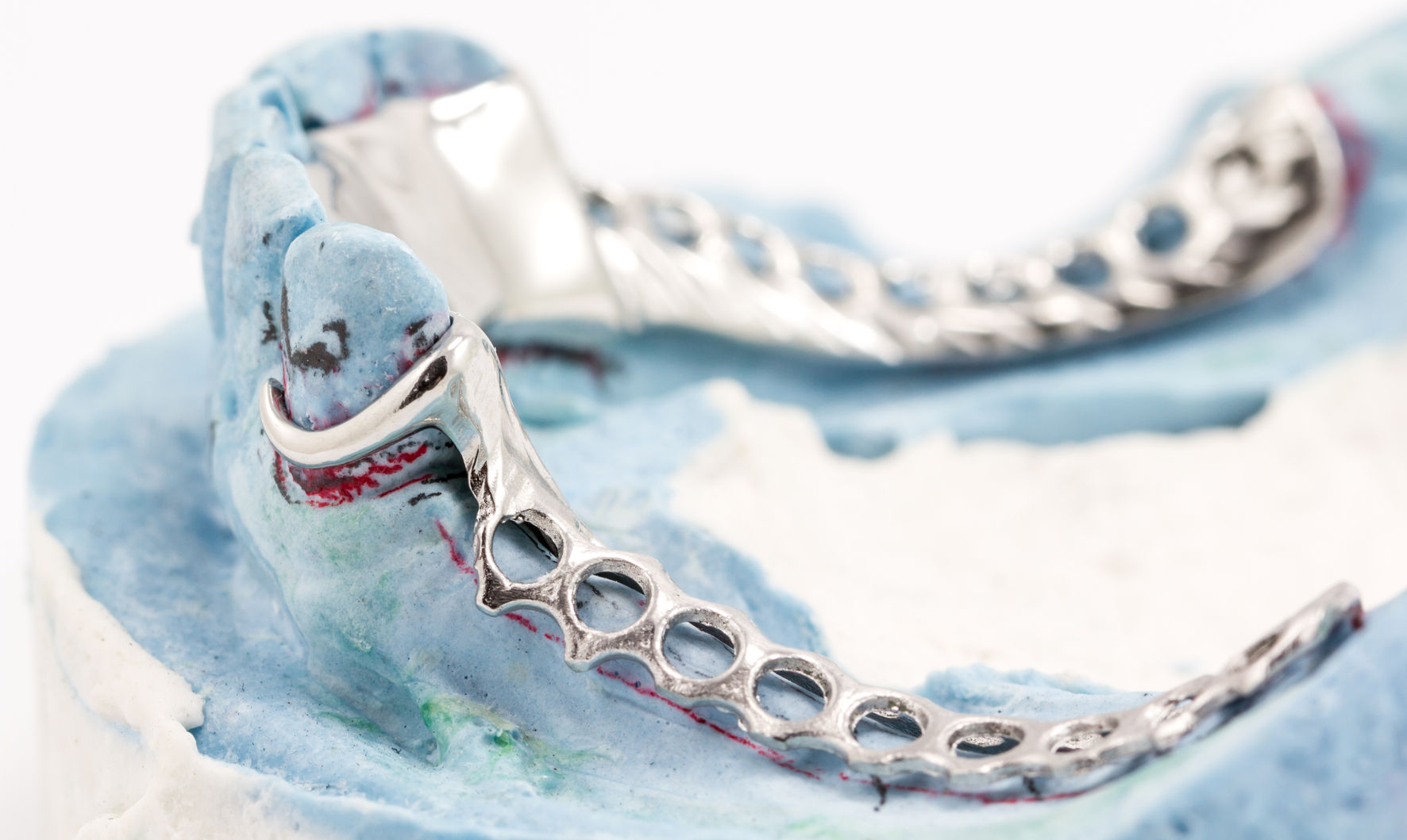 Chrome Cobalt Dentures – Dental Tech Lab